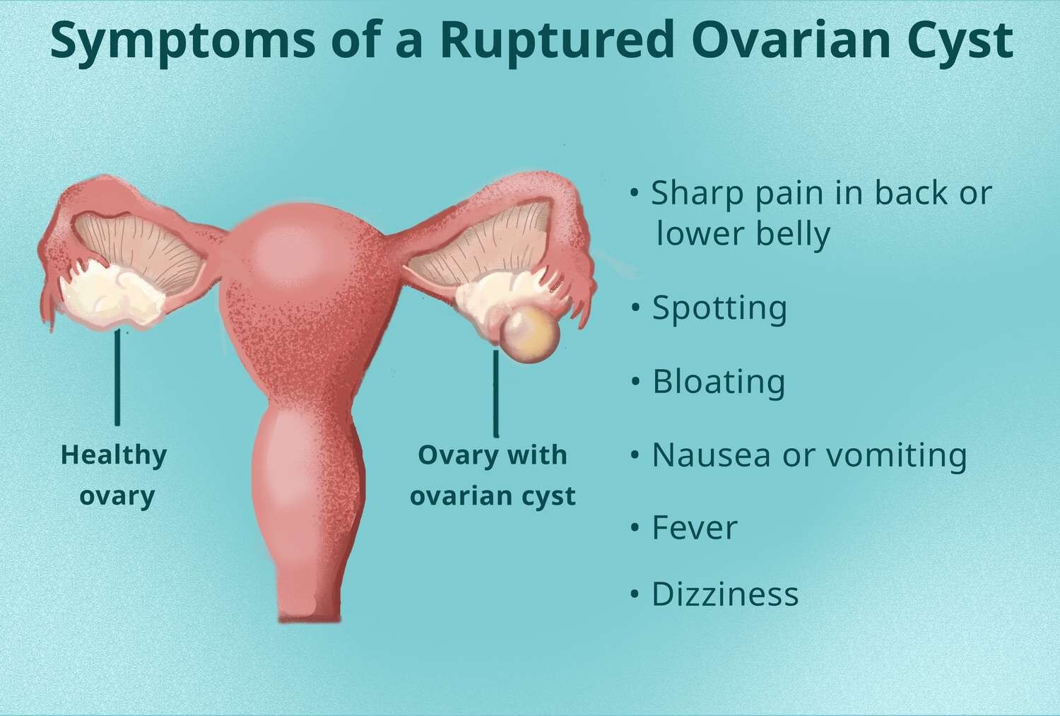 NATURAL STRONG HERBS FOR HEALTHY WOMEN OVARIAN CYST – 100% NATURAL – MADE IN USA