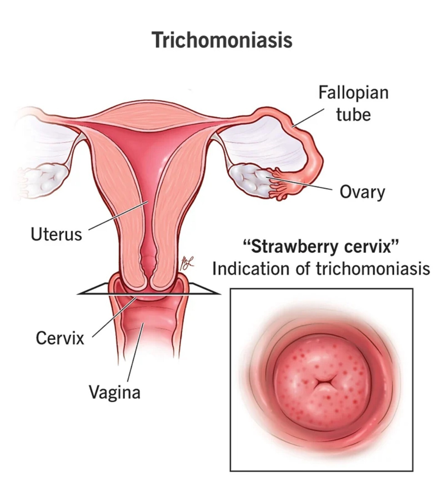 100% NATURAL HERBALS THERAPY FOR TRICHOMONIASIS STI ID 120 CAPS – MADE IN USA