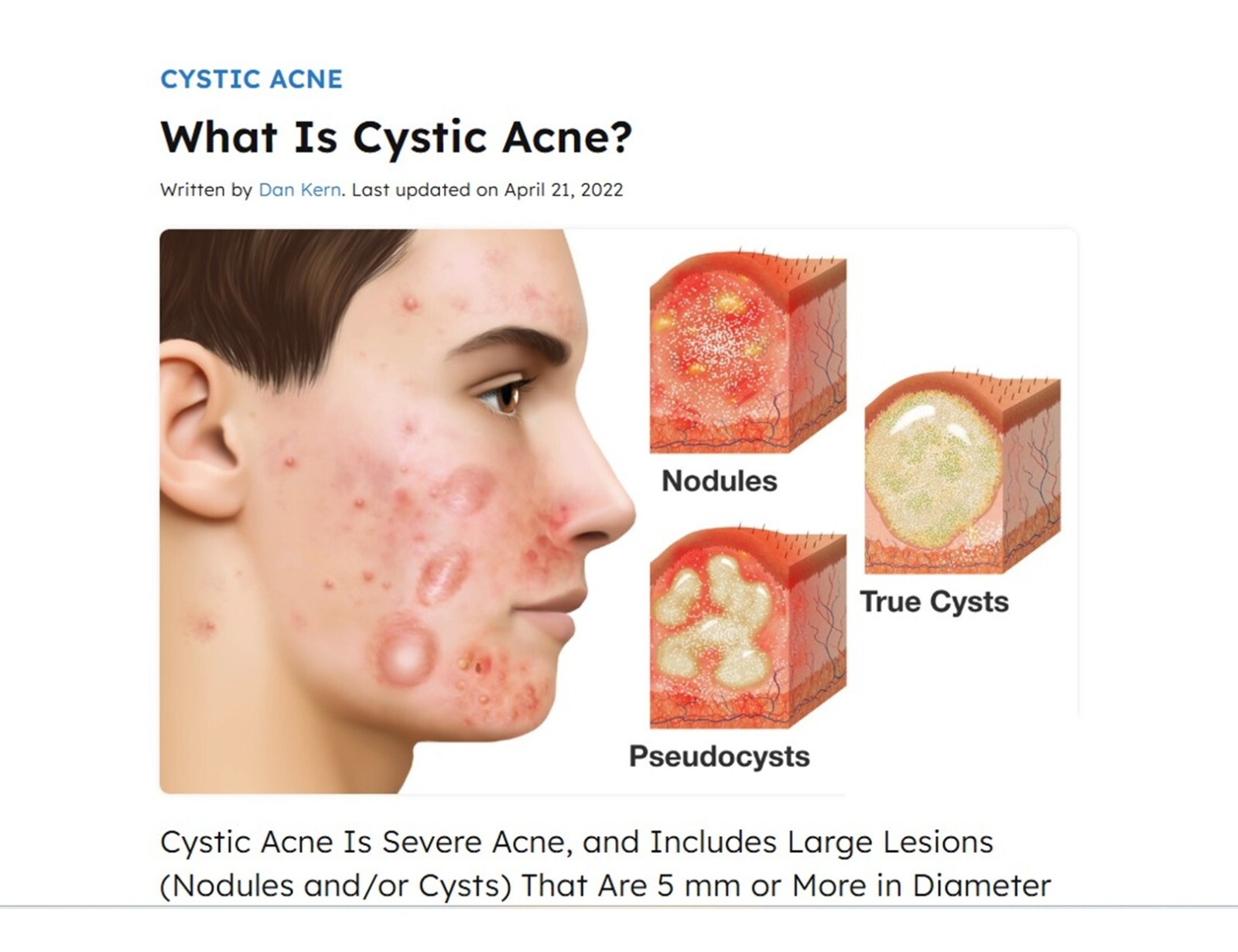 NATURAL SKIN HEALTH CYST ACNE GEL FOR PEOPLE – 100% ORGANICS – MADE IN USA