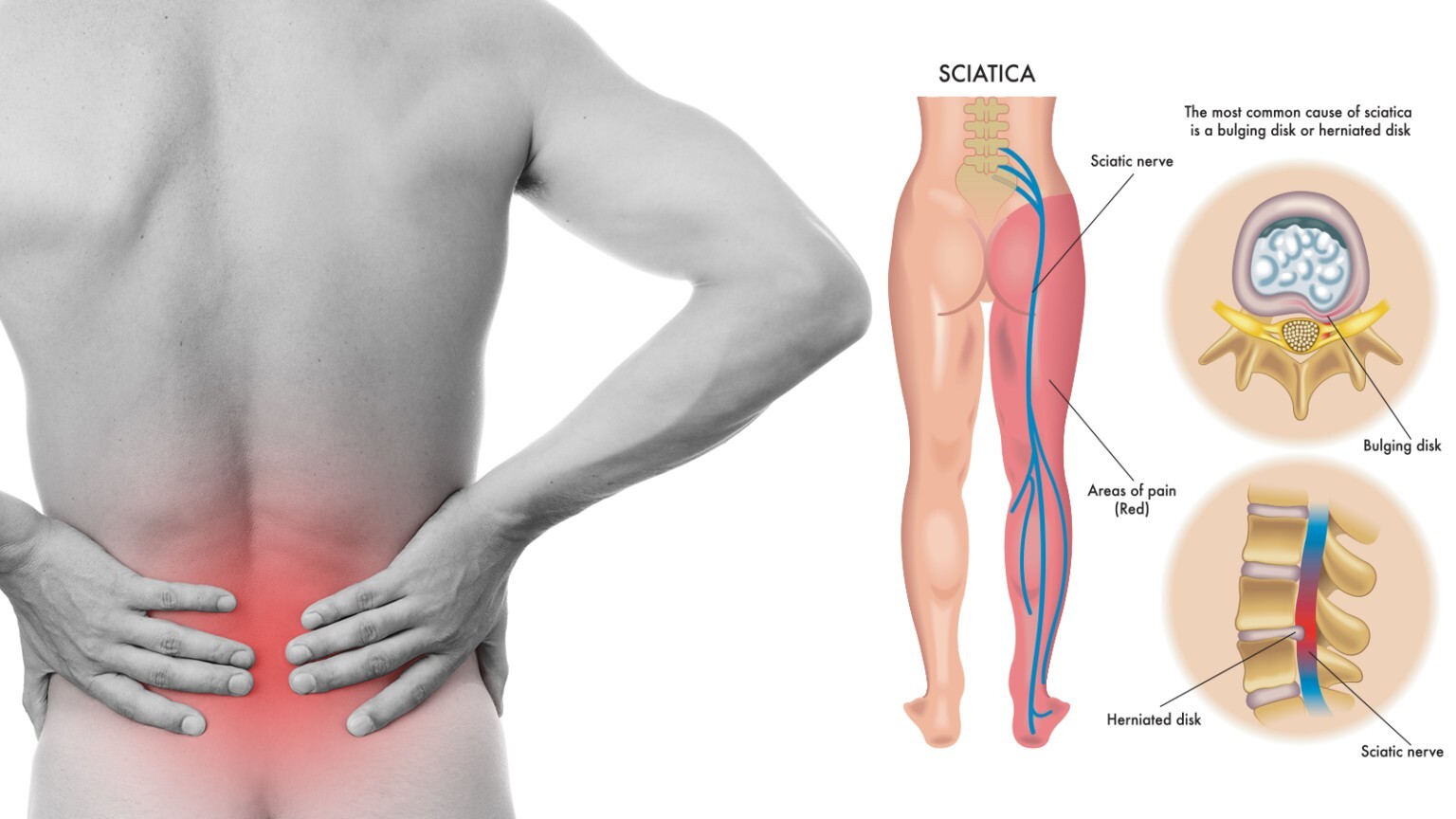 POWERFUL HERBS FOR SCIATICA PAIN IN MEN & WOMEN – 120 CAPS – MADE IN USA