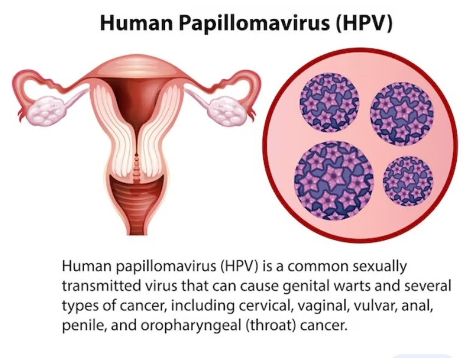 NATURAL HERBS FOR PAPILLOMA WOMEN & MEN HPV VIRUS – 120 CAPS – MADE IN USA