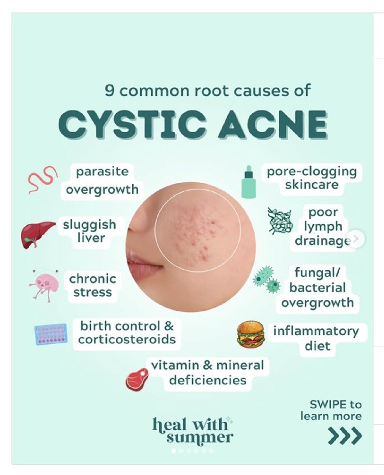 POWERFUL HERBS FOR CYST ACNE MEN WOMEN- 100% NATURAL – 120 CAPS – MADE IN USA