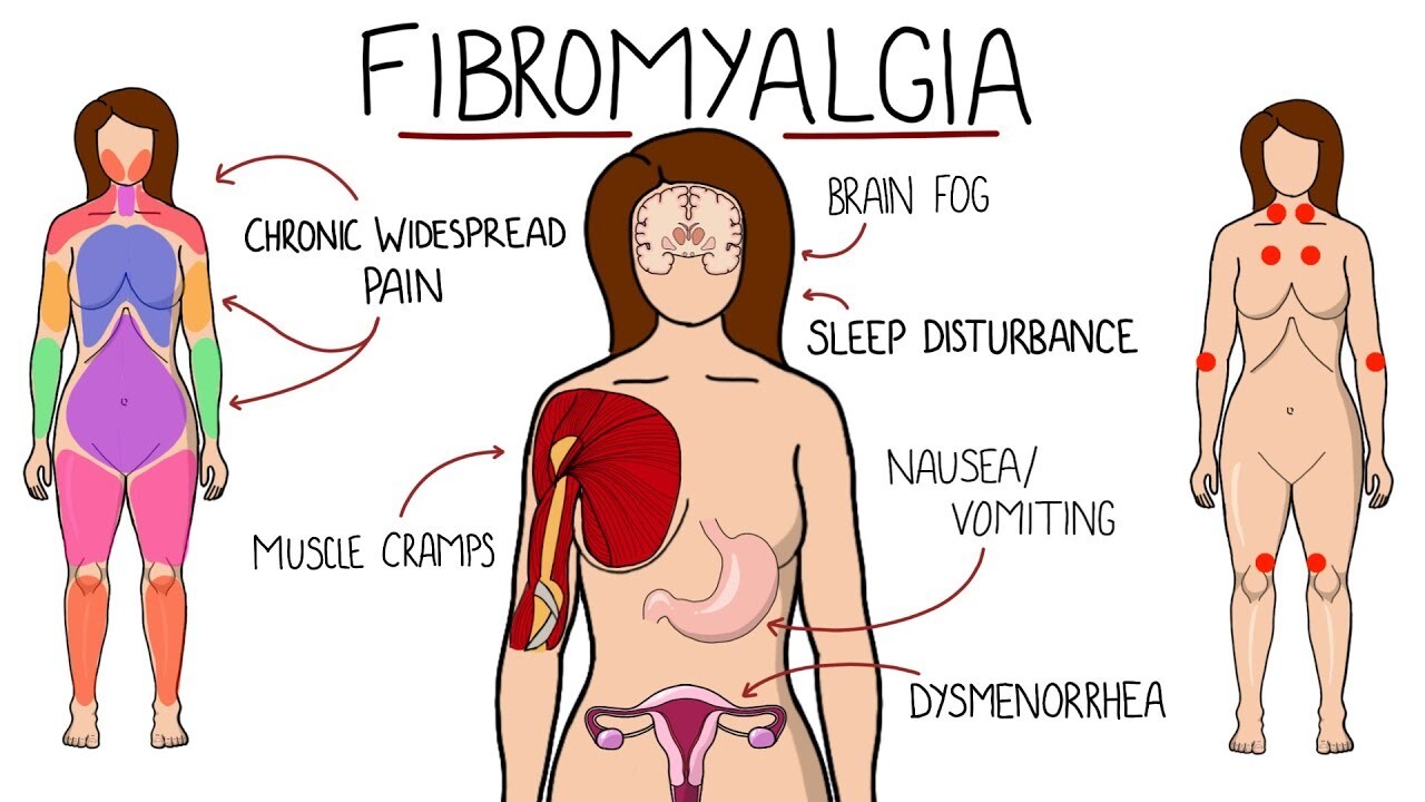 POWERFUL FIBROMYALGIA PAIN CREAM FOR WOMEN MEN – 100% HERBAL – MADE IN USA